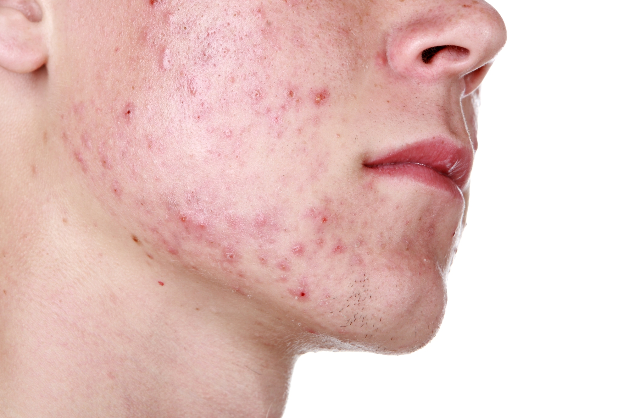 Acne close up (1)